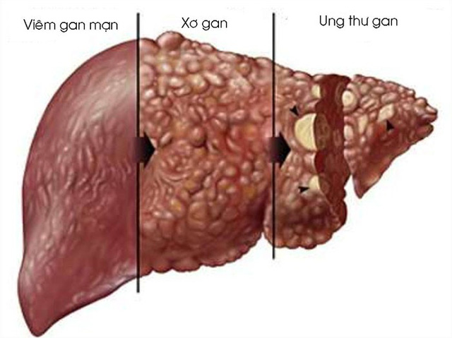Chronic hepatitis - Hình ảnh minh họa